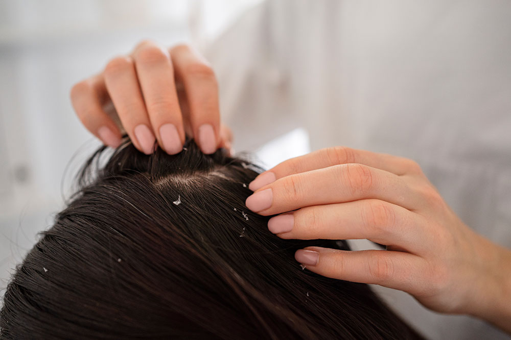 Best-Home-Remedies-for-Itchy-Scalp