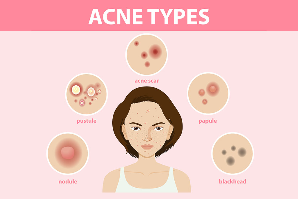 How-to-Get-Rid-of-Pimples